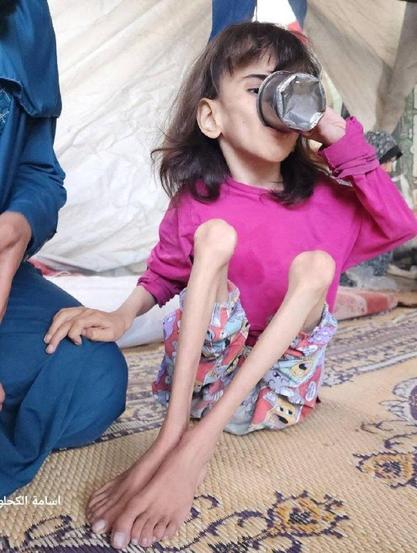 Picture of a young girl is suffering from extreme malnutrition due to Israeli total blockade of Gaza