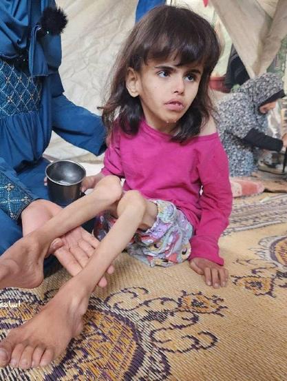 Picture of a young girl is suffering from extreme malnutrition due to Israeli total blockade of Gaza