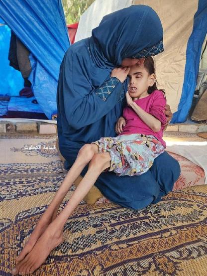 Picture of a young girl is suffering from extreme malnutrition due to Israeli total blockade of Gaza
